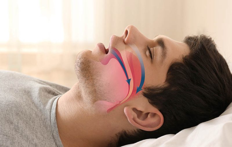 Apneia do Sono - Diagnóstico e Tratamento