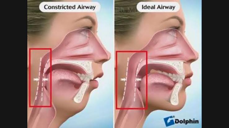 Cirurgia de Apneia do Sono