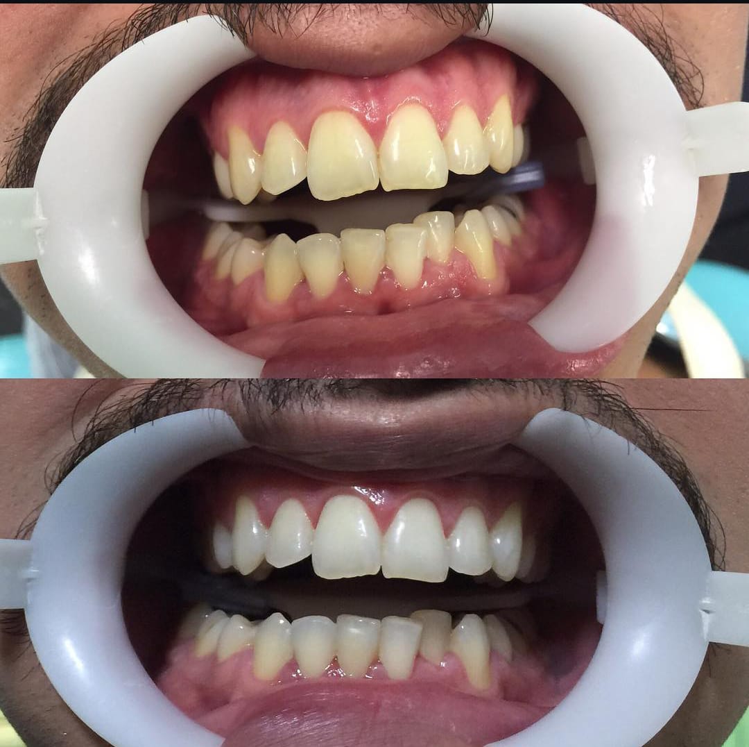 Resultado do Clareamento Dental