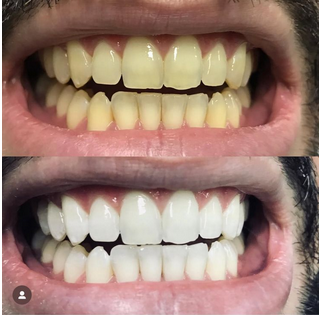 Resultado do Clareamento Dental - Caso 3