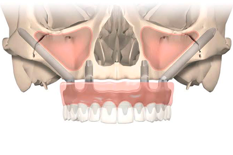 Implante Zigomático