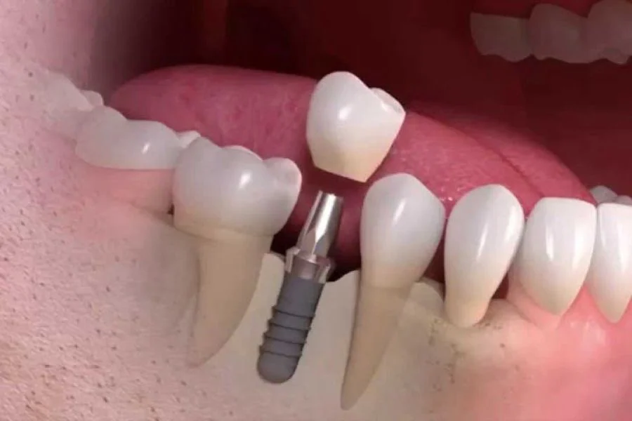 Implantes Dentários