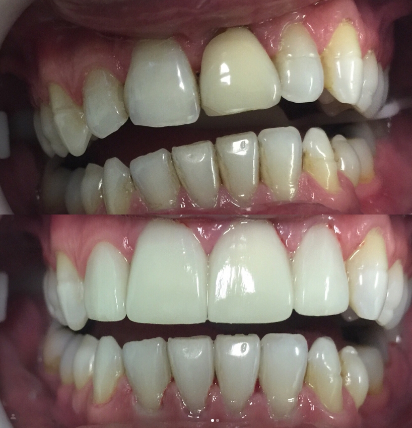 Antes e depois do tratamento com lentes de contato dental