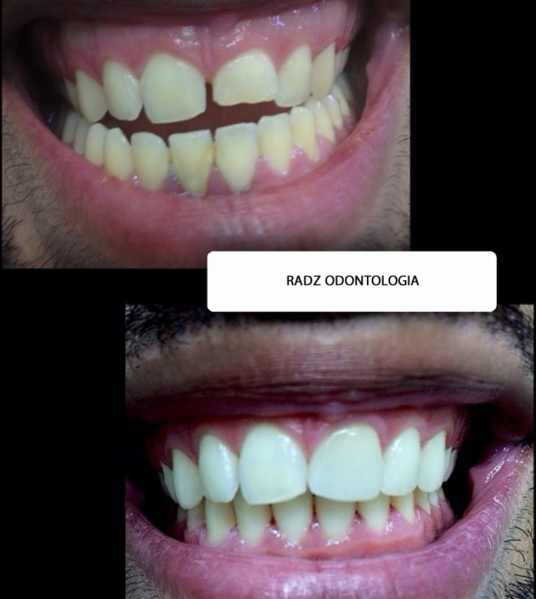 Antes e depois - Caso 2 de lentes de contato dental