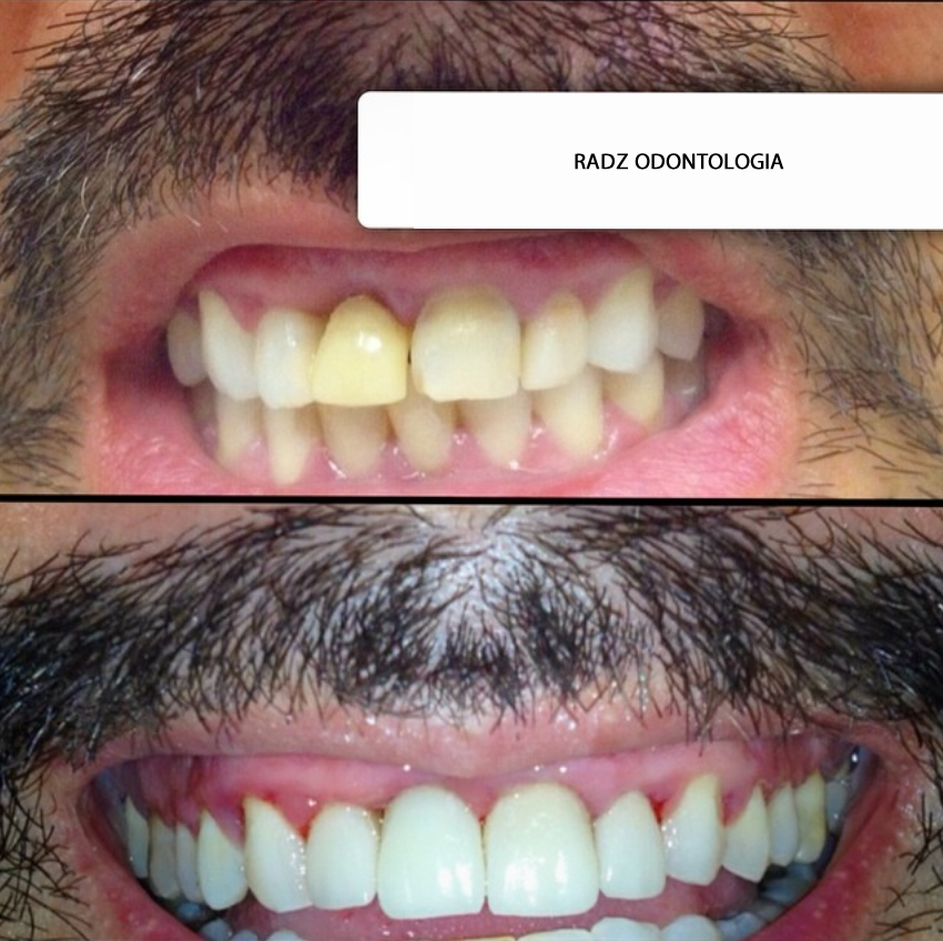 Antes e depois - Caso 3 de lentes de contato dental