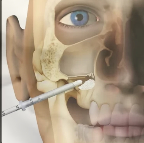 Levantamento de Membrana Sinusal - Diagnóstico