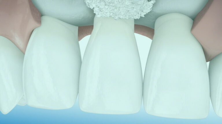 Levantamento de Membrana Sinusal - Procedimento