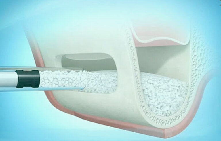 Levantamento de Membrana Sinusal - Resultado