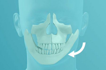 Mordida Aberta - Antes