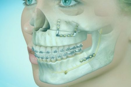 Mordida Aberta - Depois