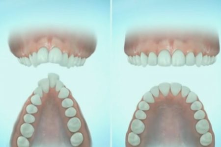 Expansão da Maxila - Antes