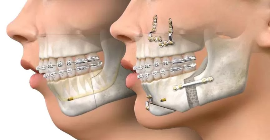 Cirurgia Ortognática