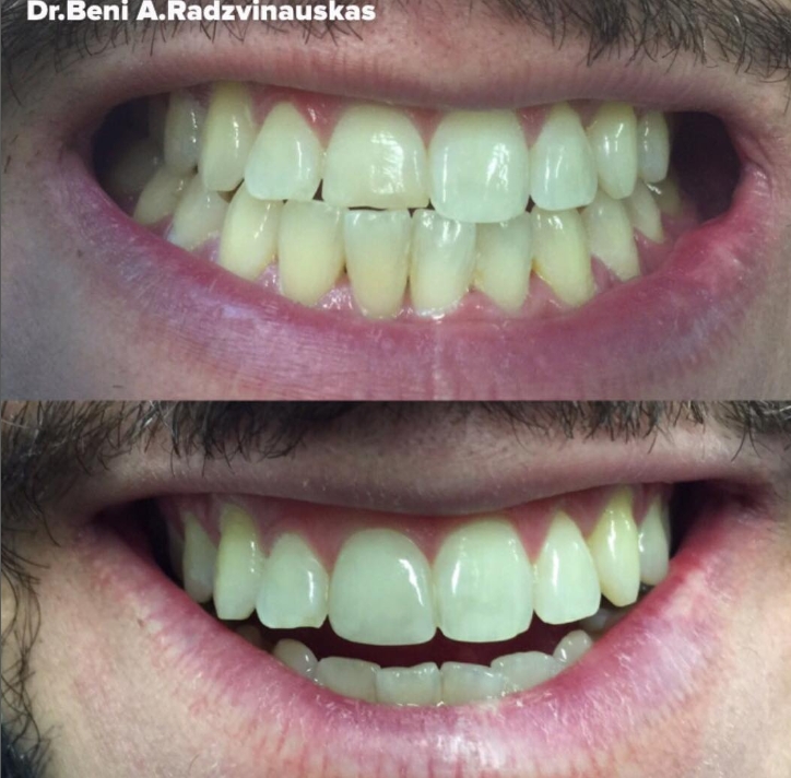 Lentes de contato em Porcelana