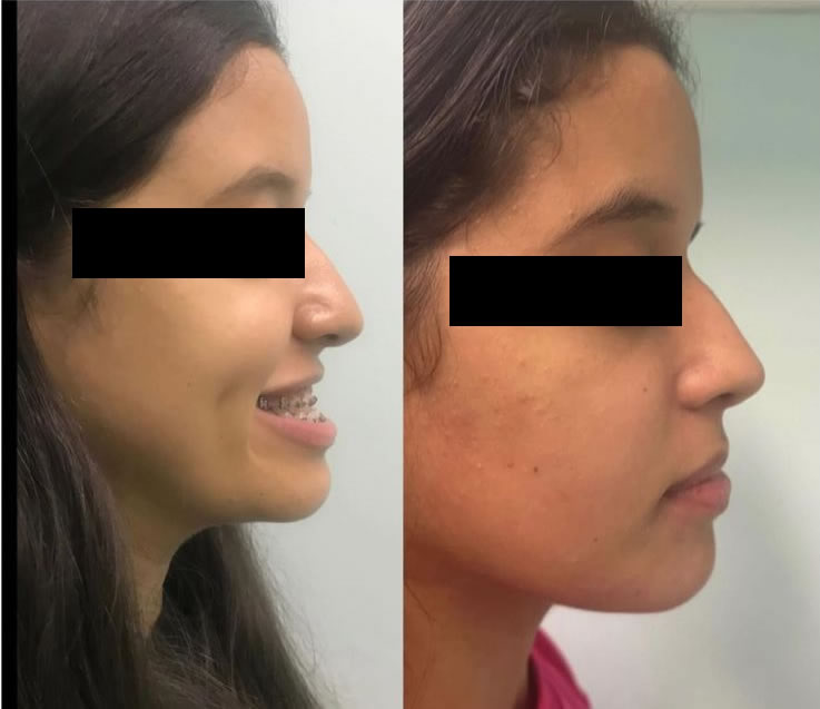 Cirurgia Ortognática