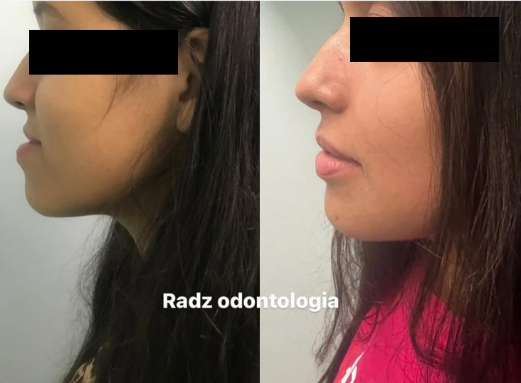 Cirurgia Ortognática