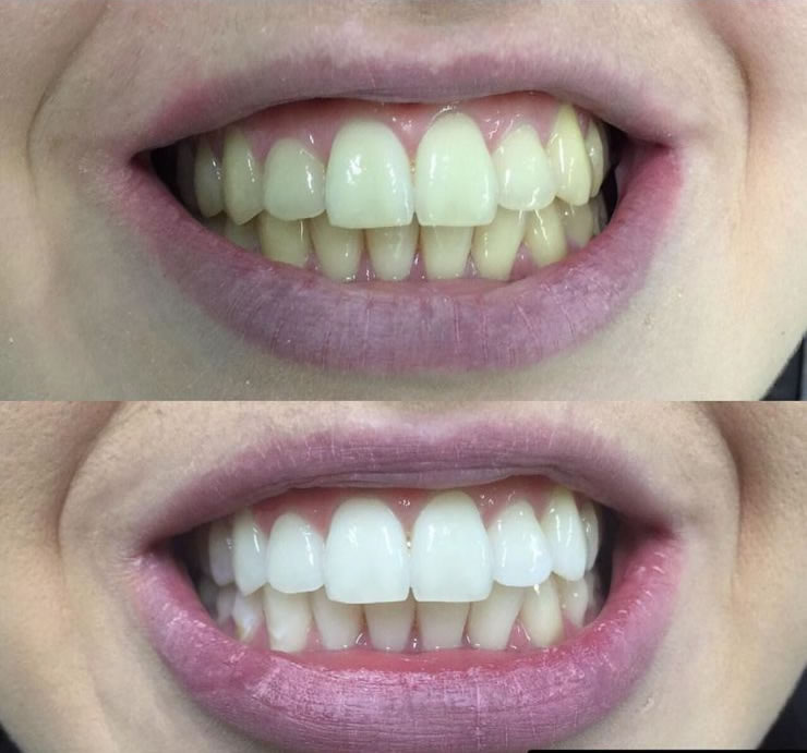 Lentes de Contato em Porcelana