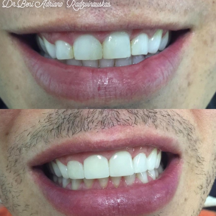 Lentes de contato em Porcelana