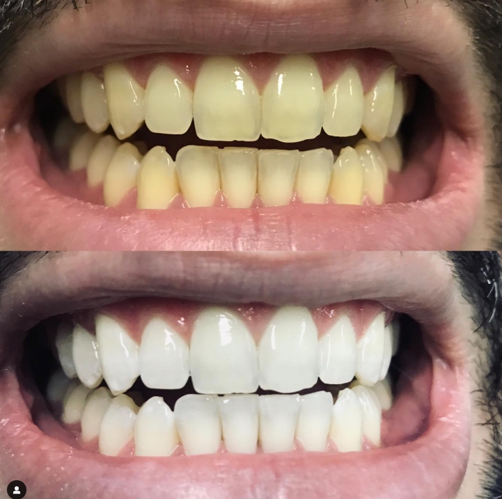 Estética e Clareamento