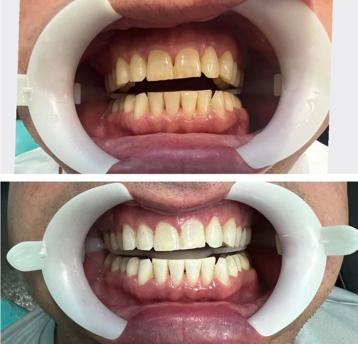 Estética e Clareamento