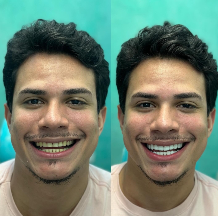 Lentes de Contato Dental