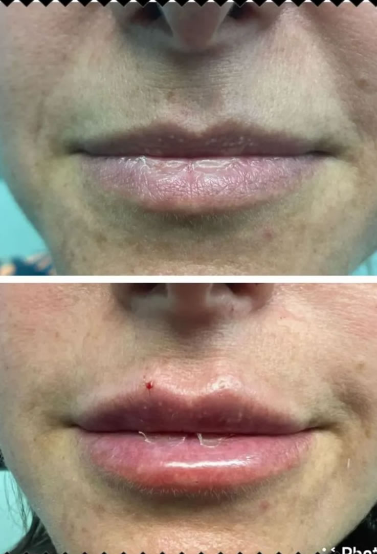 Preenchimento Labial