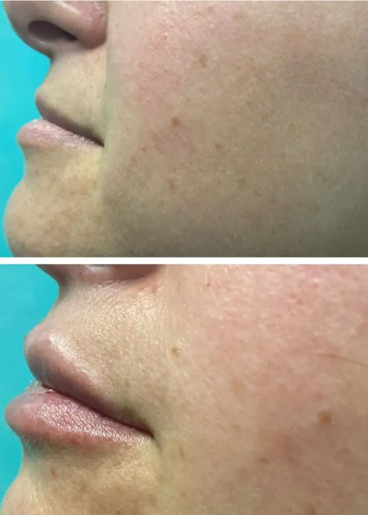 Preenchimento Labial