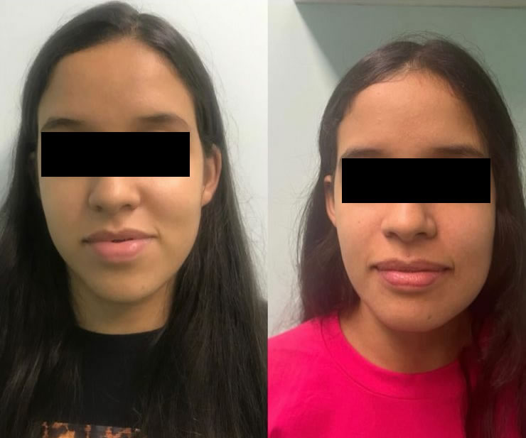 Cirurgia Ortognática