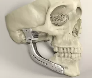 Reconstruções Ósseas