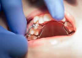 Tracionamento de Dentes